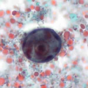 Figure C: Immature cyst of <em>E. histolytica/E. dispar</em> stained with trichrome. The cyst has large vacuoles and the chromatin around the nucleus is clumpy. Image taken at 1000x oil magnification and contributed by the Kansas Department of Health and Environment.