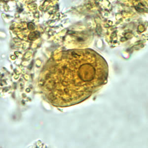 Figure B: Trophozoite of <em>E. histolytica/E. dispar</em> in a direct wet mount stained with iodine.