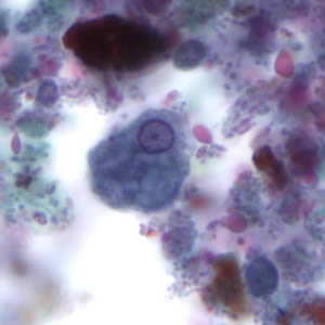 Figure C: Trophozoite of <em>E. histolytica</em>. The specimen was preserved in poly-vinyl alcohol (PVA) and stained with trichrome. PCR was performed on this specimen to differentiate between <em>E. histolytica</em> and <em>E. dispar</em>.