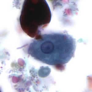 Figure D: Trophozoite of <em>E. histolytica</em>. The specimen was preserved in poly-vinyl alcohol (PVA) and stained with trichrome. The vacuolated cytoplasm seen in this image may be the result of less than optimal preservation. PCR was performed on this specimen to differentiate between <em>E. histolytica</em> and <em>E. dispar</em>.