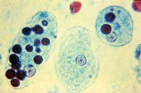 Figure B: Trophozoites of <em>E. histolytica</em> with ingested erythrocytes stained with trichrome. The ingested erythrocytes appear as dark inclusions. The parasites above show nuclei that have the typical small, centrally located karyosome, and thin, uniform peripheral chromatin.