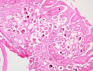 Figure B: Thin-shelled <em>A. costaricensis</em> eggs in intestinal tissue stained with H&E from the same specimen as Figure A, higher magnification. Note the varying stages of larval development.  