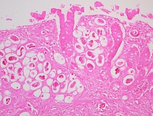 Figure C: Another view of thin-shelled <em>A. costaricensis</em> eggs in intestinal tissue stained with H&E from the same specimen as Figure A. Note the varying stages of larval development.  