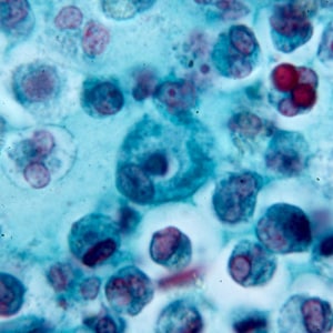 Figure A: White blood cells in a trichrome-stained stool smear.