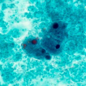 Figure B: Macrophages in a trichrome-stained stool smear.