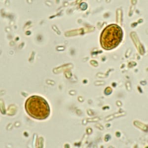 Figure A: Yeast in an iodine-stained concentrated wet mount of stool. Yeast in wet mounts may be confused for <em>Giardia</em>.