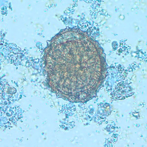 Figure A: Pollen grain in a concentrated wet mount of stool. This grain looks very similar to the fertile egg of <em>Ascaris lumbricoides</em>, although the spine-like structures on the outer layer should separate the two.