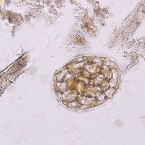 Figure A: Plant cell in a concentrated wet mount of stool. Such material can be common in stool and may be confused for helminth eggs, although they are usually much larger than the eggs of most helminth species.