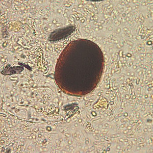 Figure B: Plant material in an iodine-stained concentrated wet mount of stool. This material can be confused for a hookworm egg. Image courtesy of the Alaska State Public Health Laboratory.