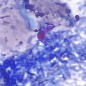 Figure A: Yeast in an acid-fast stained stool specimen. These may be confused for the oocysts of <em>Cryptosporidium</em> sp. Images courtesy of the Arizona State Public Health Laboratory.