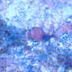 Figure E: Object, probably fungal, in an acid-fast stained stool specimen. Such objects may be confused for the oocysts of <em>Cyclospora</em> spp.