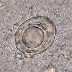 Figure A: Unknown object in a concentrated stool specimen. This object looks like the egg of <em>Hymenolepis</em> but lacks refractile hooks and the polar filaments seen in <em>H. nana</em>.