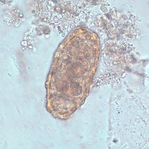 Figure C: Unfertilized egg of <em>A. lumbricoides</em> in an unstained wet mount of stool.