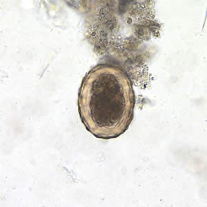 Figure F: Fertilized egg of <em>A. lumbricoides</em> in an unstained wet mount of stool.