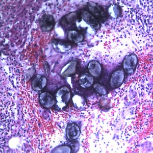 Figure C: Eggs of <em>A. lumbricoides</em> in an appendix biopsy, stained with H&E. This image was taken at 200x magnification.