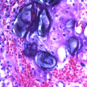 Figure D: Eggs of <em>A. lumbricoides</em> in an appendix biopsy, stained with H&E. This image was taken at 400x magnification.