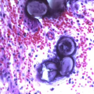 Figure E: Eggs of <em>A. lumbricoides</em> in an appendix biopsy, stained with H&E. Image taken at 400x magnification.