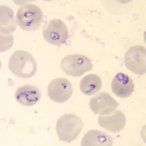 Babesia in red blood cells from cdc.gov