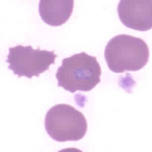 Figure E: <em>Babesia</em> sp. in a thin blood smear stained with Giemsa. Image contributed by the Arizona State Health Laboratory.