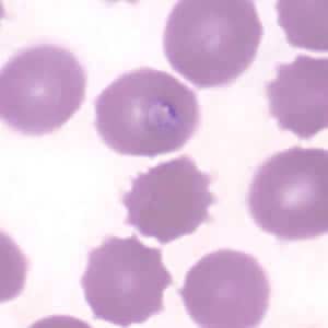 Figure F: <em>Babesia</em> sp. in a thin blood smear stained with Giemsa. Image contributed by the Arizona State Health Laboratory.