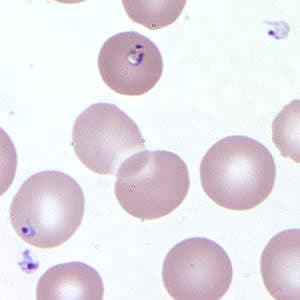 Figure B: <em>Babesia</em> sp. in a thin blood smear stained with Giemsa. Note the extracellular forms as well as intra-erythrocytic forms, one of which is vacuolated.