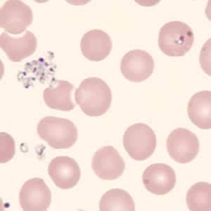Figure C: <em>Babesia</em> sp. in a thin blood smear stained with Giemsa, showing extracellular forms. Image was courtesy of the Connecticut Department of Public Health Laboratory.