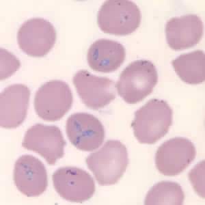 Figure A: <em>Babesia microti</em> in a thin blood smear stained with Giemsa. Babesia sp. cannot be identified to the species level by morphology alone; additional testing, such as PCR, is always recommended.