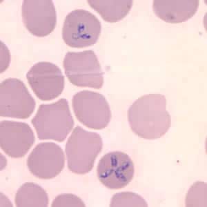 Figure B: <em>Babesia</em> microti in a thin blood smear stained with Giemsa. <em>Babesia</em> sp. cannot be identified to the species level by morphology alone; additional testing, such as PCR, is always recommended. Note the tetrad form in this image.