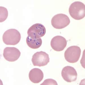 Figure C: <em>Babesia</em> MO-1 in a thin blood smear stained with Giemsa.