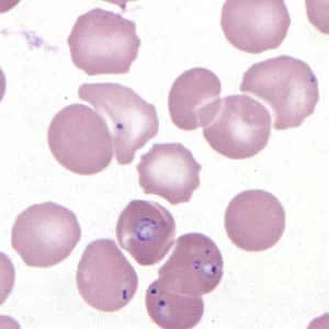Figure D: <em>Babesia</em> MO-1 in a thin blood smear stained with Giemsa.