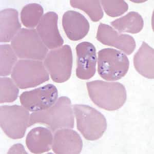Figure E: <em>Babesia</em> MO-1 in a thin blood smear stained with Giemsa.