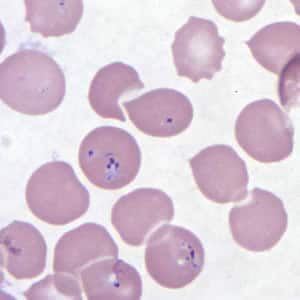 Figure F: <em>Babesia</em> MO-1 in a thin blood smear stained with Giemsa.