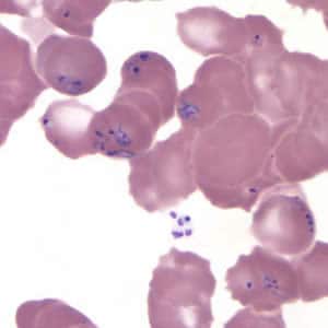 Figure G: <em>Babesia</em> MO-1 in a thin blood smear stained with Giemsa. Babesia sp. cannot be identified to the species level by morphology alone; additional testing, such as PCR, is always recommended.