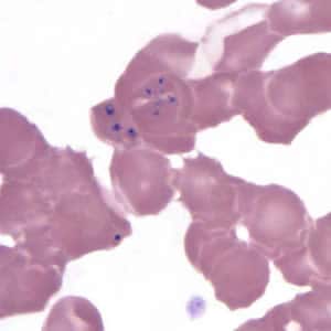 Figure I: <em>Babesia</em> MO-1 in a thin blood smear stained with Giemsa.