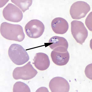 Figure A: <em>Babesia</em> MO-1 in a thin blood smear stained with Giemsa. Babesia sp. cannot be identified to the species level by morphology alone; additional testing, such as PCR, is always recommended. Note the vacuolated parasites (black arrows) in the image.