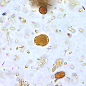 a blastocystis hominis parazitái)