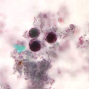 a blastocystis hominis parazitái
