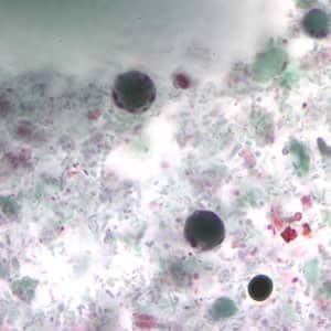 paraziták a blastocystis hominis)