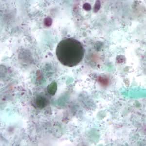 a blastocystis hominis parazitái)