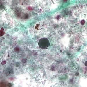 a blastocystis hominis parazitái szemölcsök terhesség gyakori