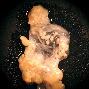 Figure B: Close-up of a coenurus of <em>T. multiceps</em> removed from the eye of a patient, broken open to show multiple protoscolices.