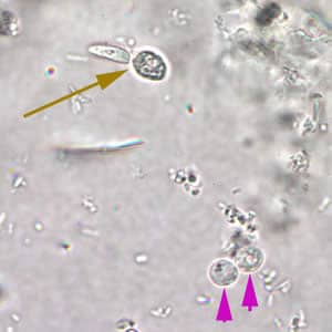 Figure A: <em>Cryptosporidium</em> spp. oocysts (pink arrows) in wet mount. A budding yeast (brown arrow) is in the same field.
