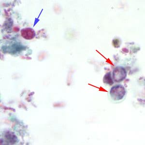 Figure A: <em>Cryptosporidium</em> sp. oocysts stained with trichrome. Oocysts may be detected, but should not be confirmed by this method. Trichrome staining is inadequate for a definite diagnosis because oocysts will appear unstained. Here the <em>Cryptosporidium</em> oocysts are represented by red arrows; the blue arrow represents yeast.