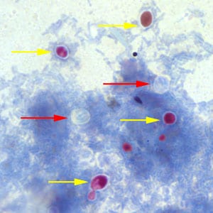 Figure A: <em>Cryptosporidium</em> sp. oocysts (red arrows) that did not take up the modified acid-fast stain. The slide was counterstained with methylene blue. Note that yeast cells did stain red (yellow arrows).