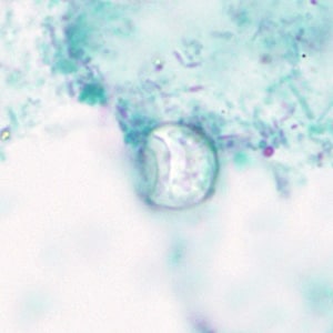 Figure A: Oocyst of <em>C. cayetanensis</em>? stained with trichrome; while the oocyst is visible, the staining characteristics are inadequate for a reliable diagnosis.