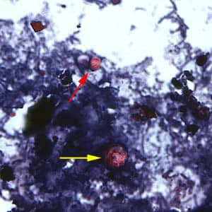 Figure F: Oocyst of <em>C. cayetanensis</em> (yellow arrow) along with an oocyst of Cryptosporidium parvum (red arrow), stained with safranin (SAF). Cryptosporidium spp. also stain with the safranin and modified acid-fast stains.