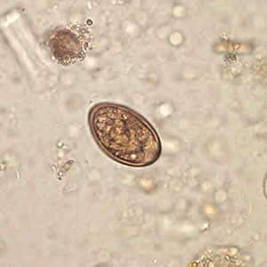 Figure A: Egg of <em>Dicrocoelium dendriticum</em> in an unstained wet mount of stool. Image courtesy of Dr. Juan Cuadros González.