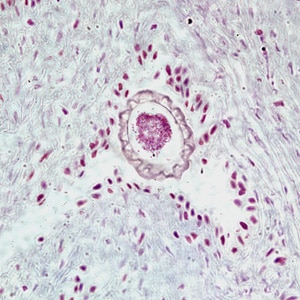 Figure A: Egg of <em>D. renale</em> in the kidney of a mink, stained with hematoxylin and eosin (H&E).