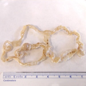 Diphyllobothriasis helminth, A széles szalag leírása Diphyllobothriasis diagnózis készítmény