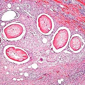 Figure C: Cross-sections of <em>Dirofilaria</em> sp. from a subcutaneous nodule above the right breast of a female patient who traveled to several western European countries, stained with H&E. Image taken at 100x magnification. Image courtesy of Dr. Truus Derks.